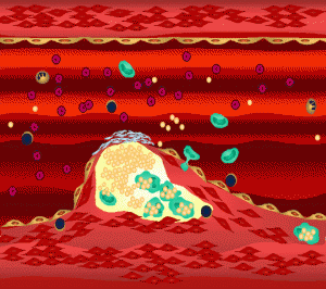 A Arteriosclerose