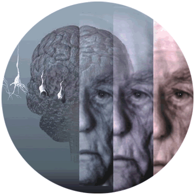 Fator de risco para o Alzheimer: doença cardíaca