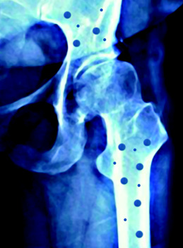 A osteoporose