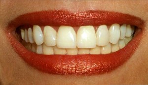 Como evitar as cáries nos dentes