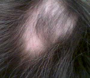 Alopecia