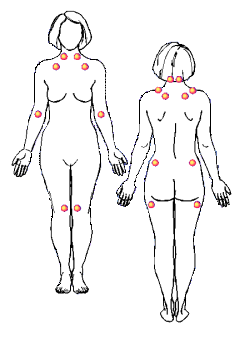 Tratamento de fibromialgia