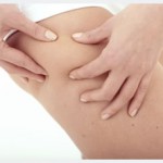 estrias estrias