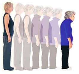 osteoporose